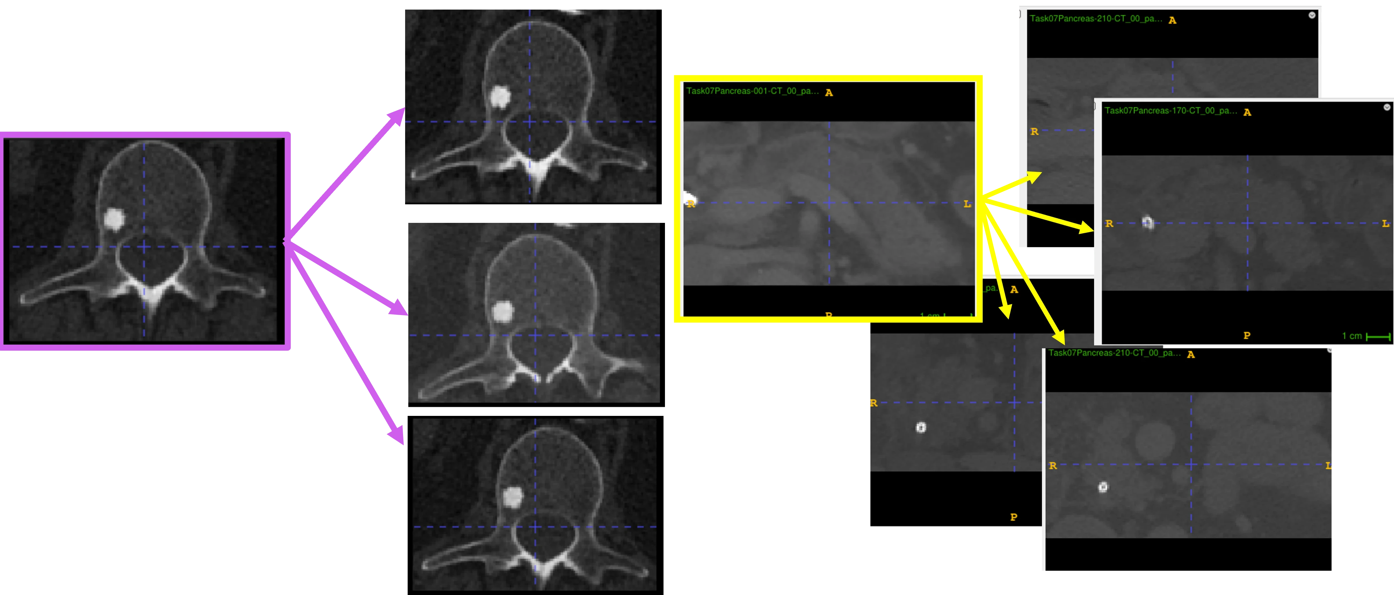 L1 Vertebra with bone island fingerprint